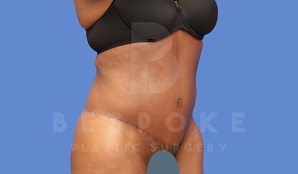 Tummy Tuck Gallery - Patient 4709961 - Image 4