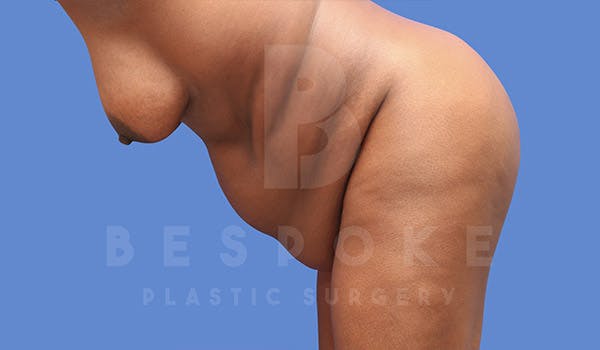 Tummy Tuck Before & After Gallery - Patient 4709961 - Image 5