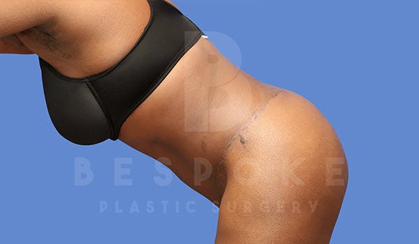 Tummy Tuck Before & After Gallery - Patient 4709961 - Image 6