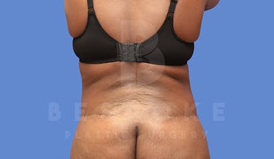 Tummy Tuck Before & After Gallery - Patient 4709961 - Image 8