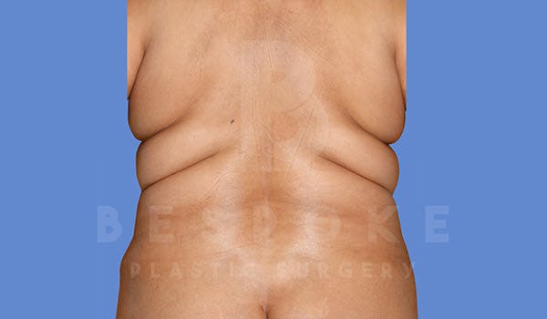 Liposuction Before & After Gallery - Patient 4709981 - Image 1