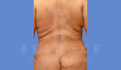 Liposuction Before & After Gallery - Patient 4709981 - Image 2
