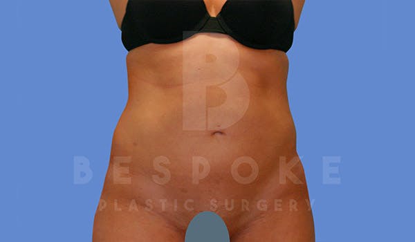 Liposuction Before & After Gallery - Patient 4709982 - Image 2