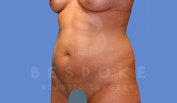 Liposuction Before & After Gallery - Patient 4709982 - Image 3