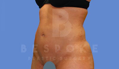 Liposuction Before & After Gallery - Patient 4709982 - Image 4