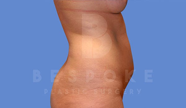 Liposuction Gallery - Patient 4709982 - Image 5