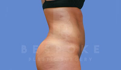 Liposuction Before & After Gallery - Patient 4709982 - Image 6