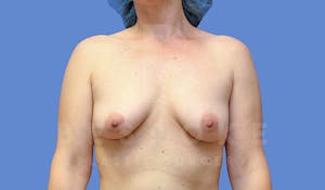 Before & After Mommy Makeover Photos