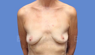 Breast Augmentation Before & After Gallery - Patient 4710013 - Image 1