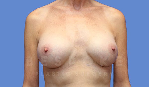 Breast Augmentation Before & After Gallery - Patient 4710013 - Image 2