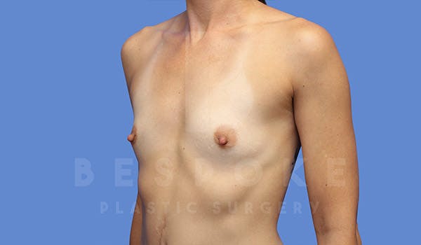 Breast Augmentation Before & After Gallery - Patient 4710014 - Image 3