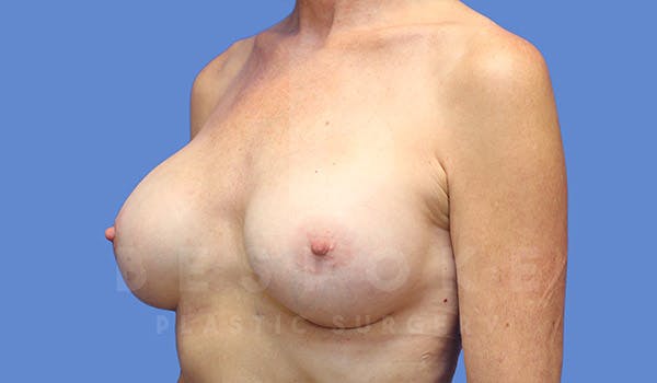 Breast Augmentation Before & After Gallery - Patient 4710013 - Image 4