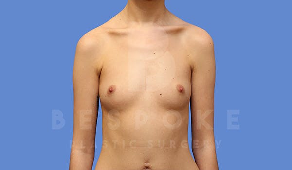 Breast Augmentation Before & After Gallery - Patient 4710015 - Image 1