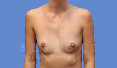 Breast Augmentation Before & After Gallery - Patient 4710016 - Image 1