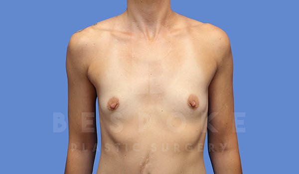 Breast Augmentation Before & After Gallery - Patient 4710014 - Image 1