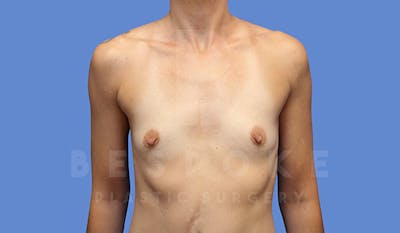 Breast Augmentation Before & After Gallery - Patient 4710014 - Image 1
