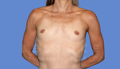 Breast Augmentation Before & After Gallery - Patient 4710017 - Image 1