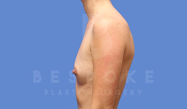 Breast Augmentation Before & After Gallery - Patient 4710016 - Image 5