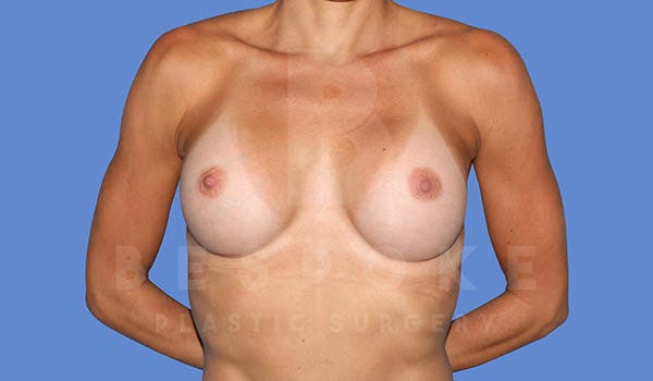 Breast Augmentation Before & After Gallery - Patient 4710017 - Image 2