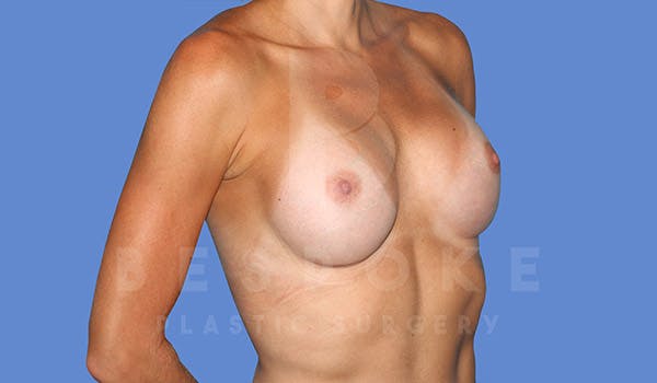 Breast Augmentation Before & After Gallery - Patient 4710017 - Image 4