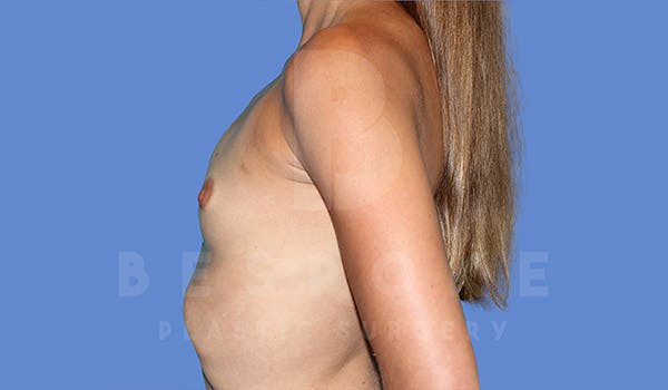 Breast Augmentation Before & After Gallery - Patient 4710017 - Image 5