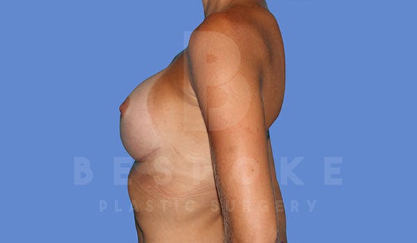 Breast Augmentation Before & After Gallery - Patient 4710017 - Image 6