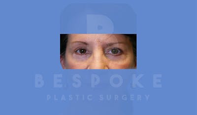 Eyelid Surgery Gallery - Patient 4757557 - Image 2