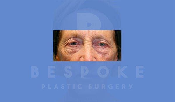 Eyelid Surgery Gallery - Patient 4757558 - Image 1