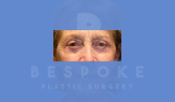 Eyelid Surgery Gallery - Patient 4757558 - Image 2