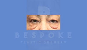 Charlotte NC Eyelid Surgery Results