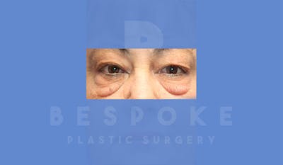 Eyelid Surgery Gallery - Patient 4757559 - Image 1
