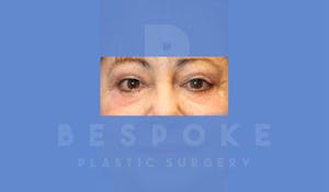 Charlotte NC Eyelid Surgery Results
