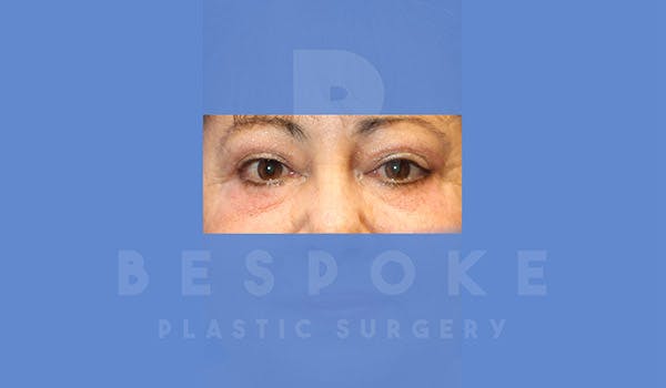Eyelid Surgery Gallery - Patient 4757559 - Image 2