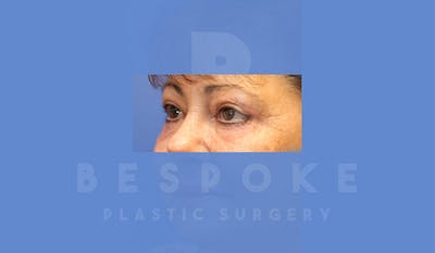 Eyelid Surgery Gallery - Patient 4757559 - Image 4