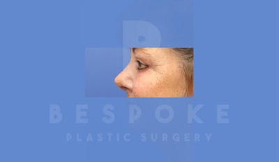 Eyelid Surgery Gallery - Patient 4757559 - Image 6