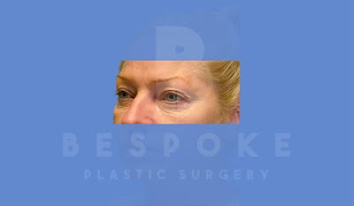Eyelid Surgery Gallery - Patient 4757560 - Image 1