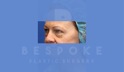 Eyelid Surgery Gallery - Patient 4757561 - Image 1