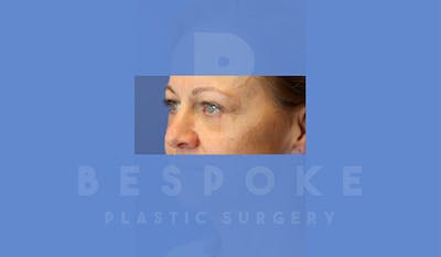 Eyelid Surgery Gallery - Patient 4757561 - Image 2