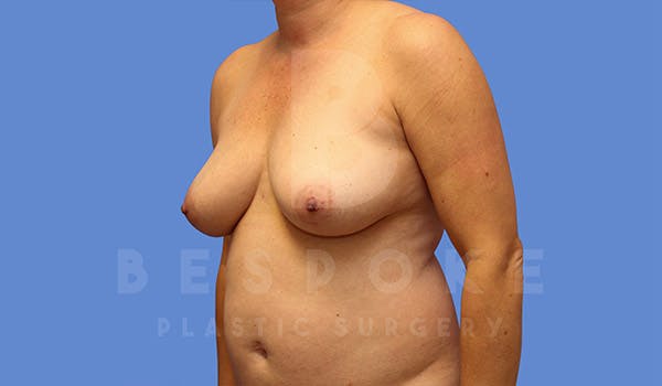 Mommy Makeover Before & After Gallery - Patient 4757566 - Image 3