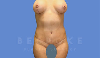 Mommy Makeover Before & After Gallery - Patient 4757567 - Image 2