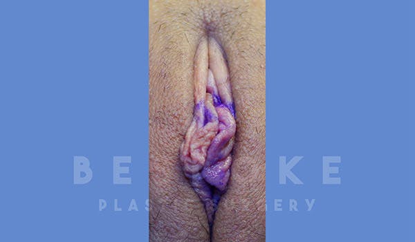 Labiaplasty Before & After Gallery - Patient 4757596 - Image 1