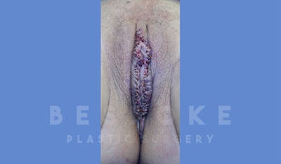 Labiaplasty Before & After Gallery - Patient 4757597 - Image 2