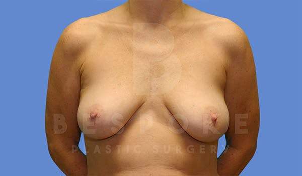 Breast Lift With Implants Before & After Gallery - Patient 4757614 - Image 1
