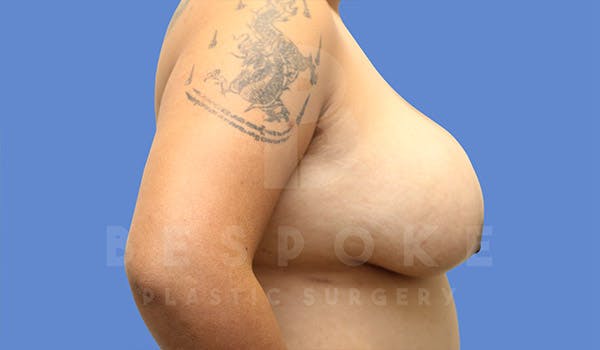 Breast Lift With Implants Before & After Gallery - Patient 4757613 - Image 5