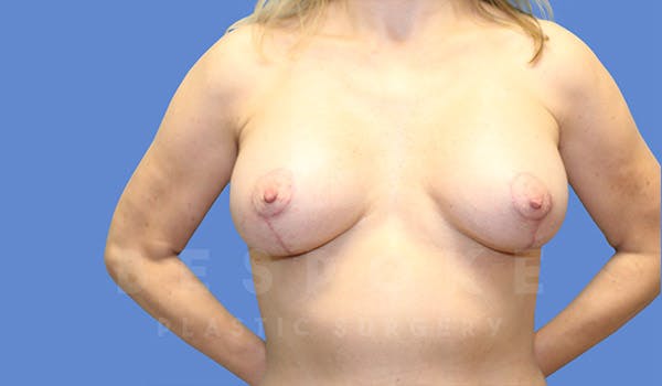Breast Lift With Implants Before & After Gallery - Patient 4757614 - Image 2