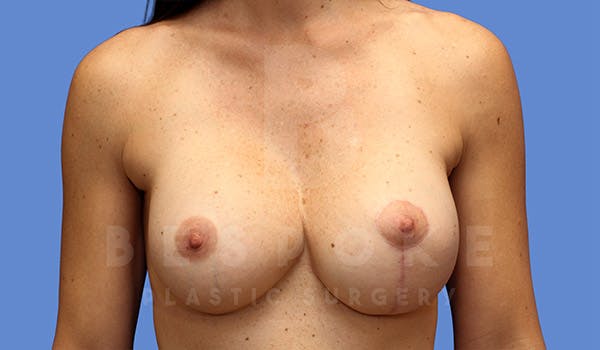 Breast Lift With Implants Gallery - Patient 4757615 - Image 2