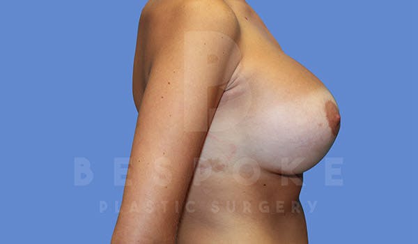Breast Revision Surgery Before & After Gallery - Patient 4757626 - Image 6
