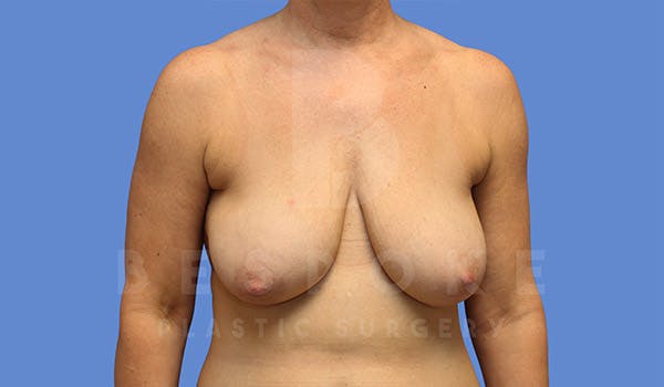 Breast Lift Gallery - Patient 4757638 - Image 1