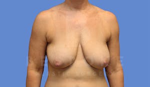 Breast Lift Before and After in Charlotte NC