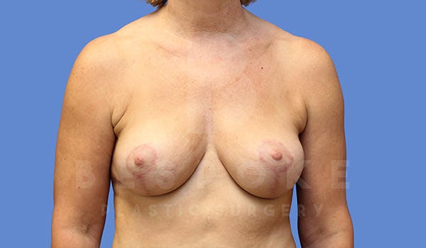 Breast Lift (No Implants) Before & After Gallery - Patient 4757638 - Image 2